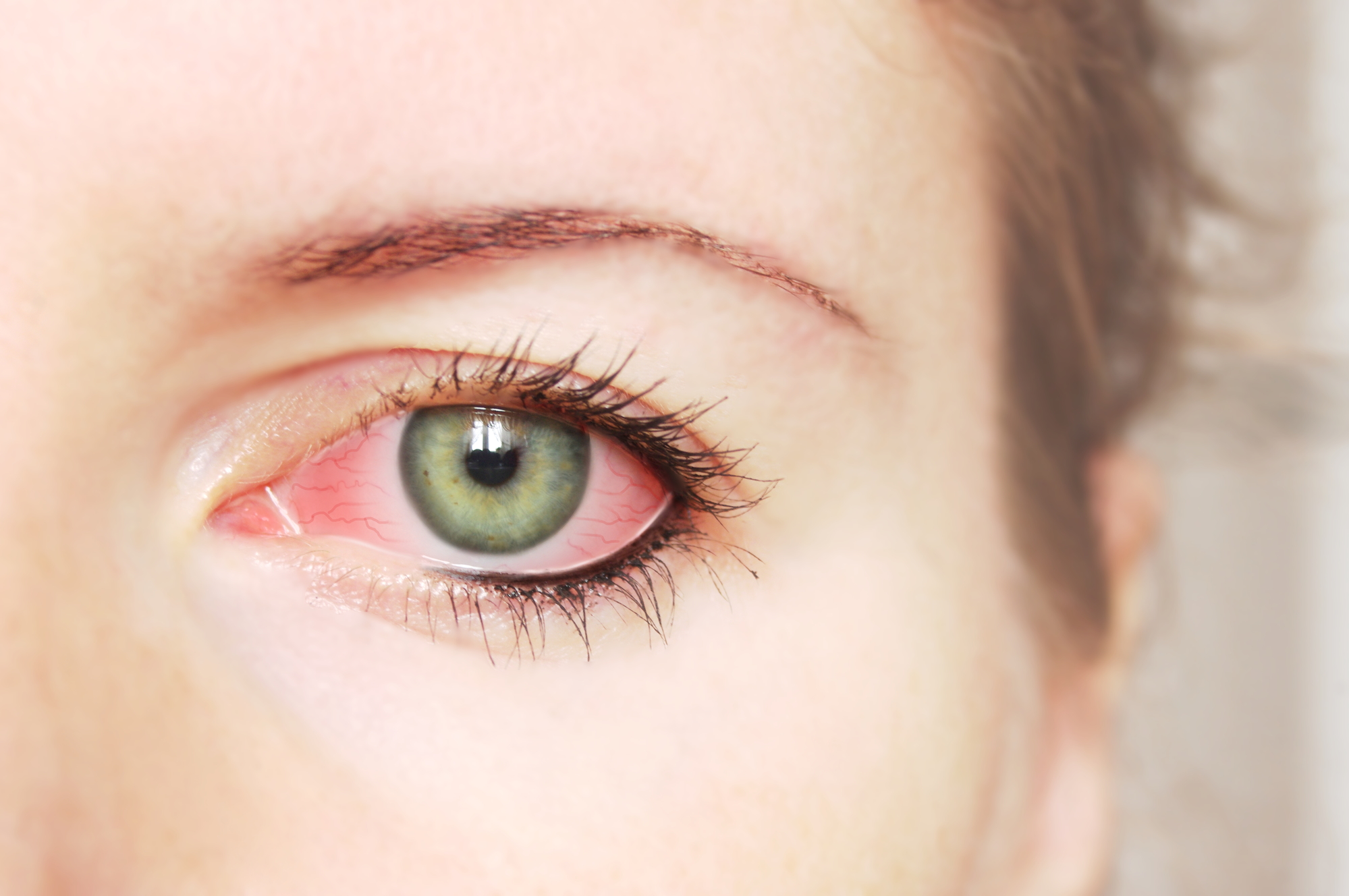 allergic individuals may notice include itchy eyes, watery eyes