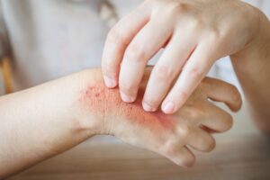 Newer Medications for Atopic Dermatitis-min